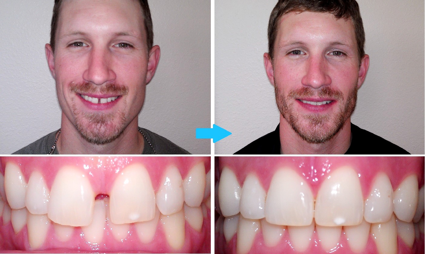 TEETH GAP TREATMENTS Smile Craft Dental Implant Centre